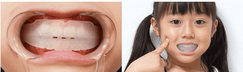 子供の歯ぎしりの原因は 正しい対策方法や歯科受診が必要なケースも説明 キレイライン矯正