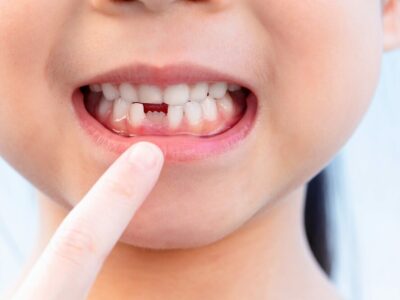 歯の生え変わり 遅い 早いで歯並びに影響はある いつどの順番で抜けるか詳しく説明 キレイライン矯正