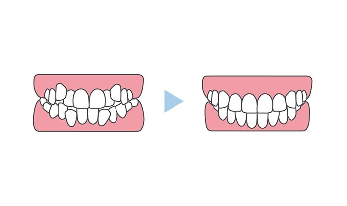 叢生と正常な歯並び