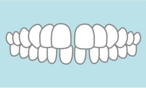 すきっ歯になる原因は？放置するリスクや歯の隙間を治す方法を紹介します