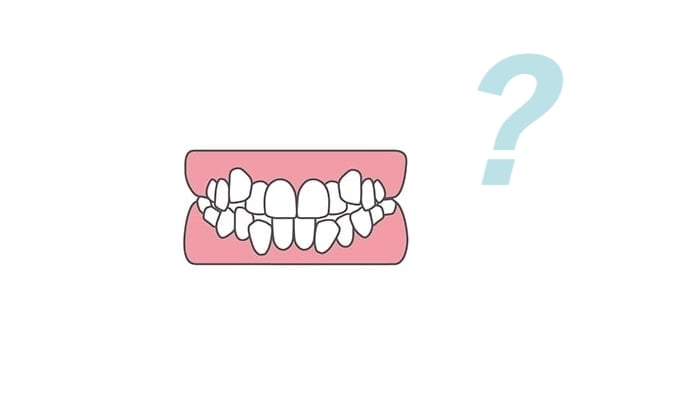 八重歯と犬歯の違い