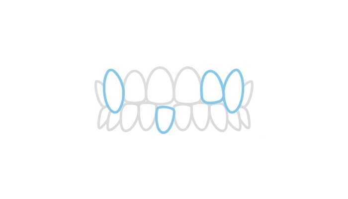 キレイライン矯正が対応できる歯並び 八重歯（叢生）