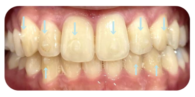 マウスピース矯正のアタッチメントって何？インビザラインやキレイ  