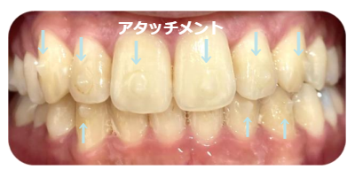 マウスピース矯正のアタッチメントって何？インビザラインやキレイ 