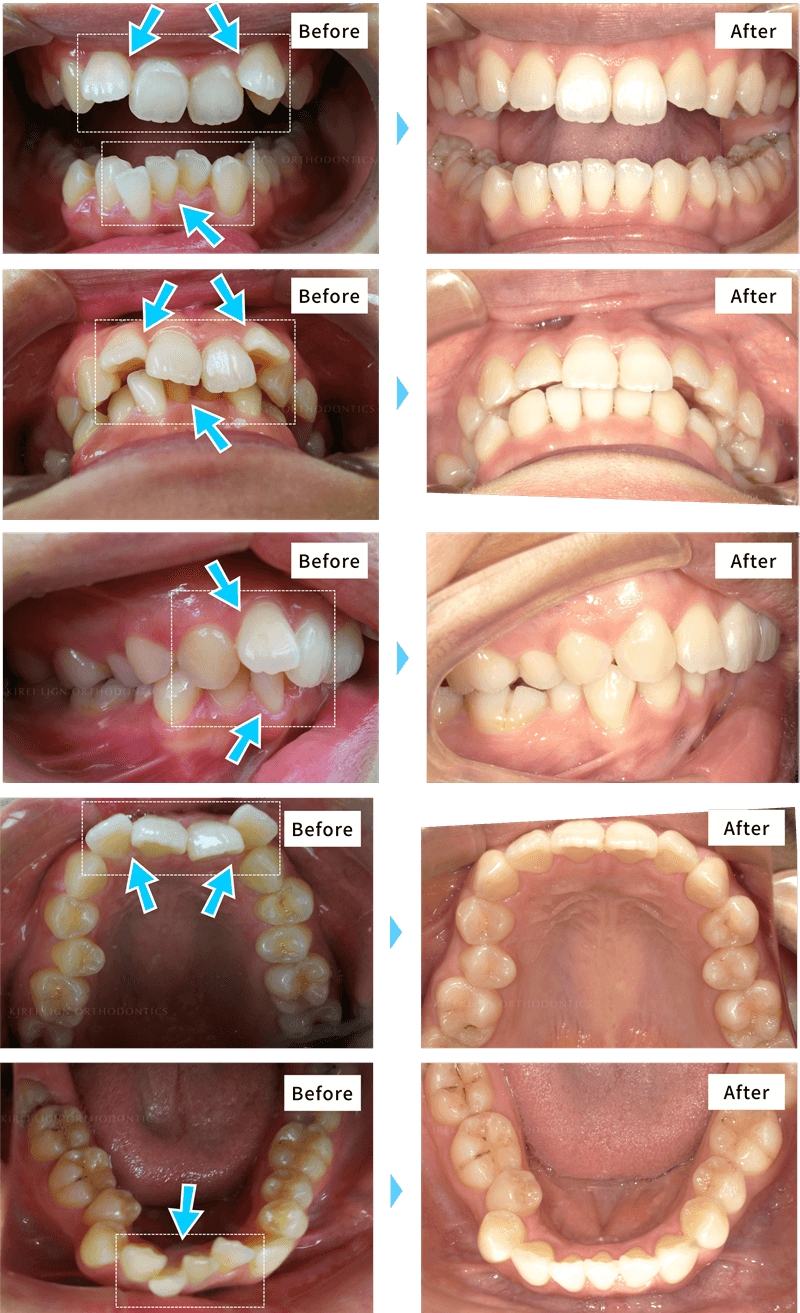 出っ歯・ガタガタの歯並び（叢生）の症例（マウスピース矯正キレイラインを10回治療）