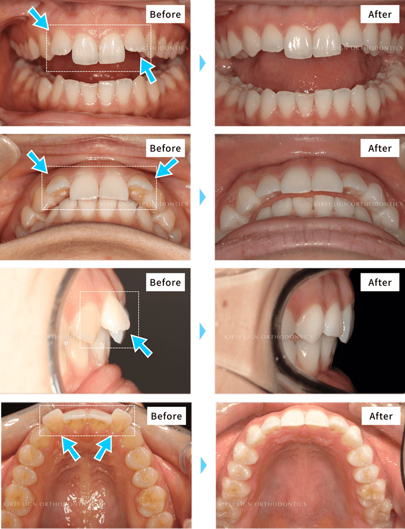 出っ歯・ガタガタの歯並び（叢生）の症例（マウスピース矯正キレイラインを5回治療）
