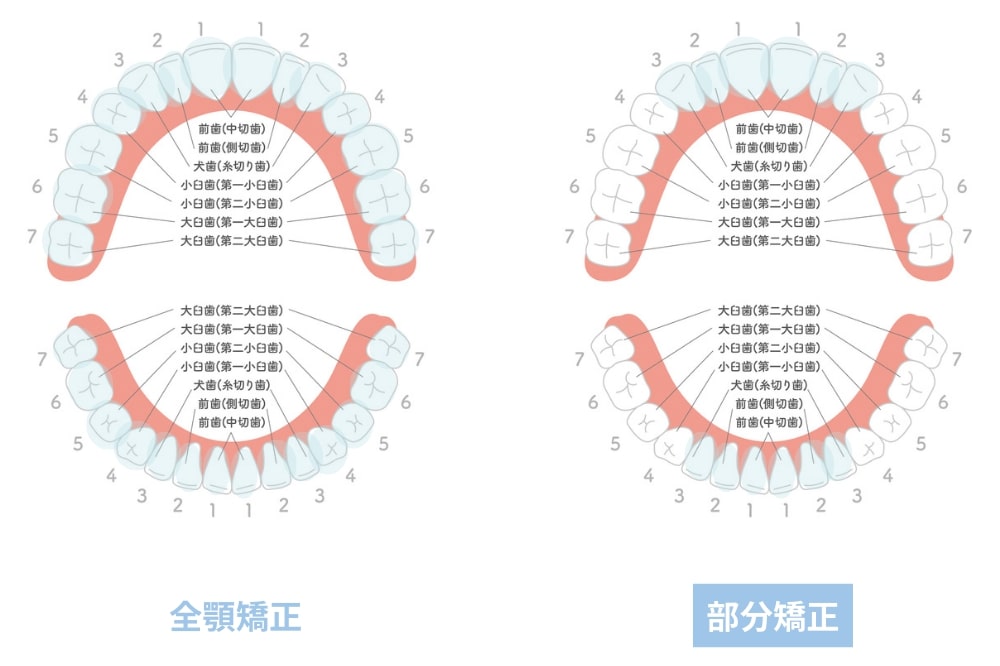 全顎矯正と部分矯正の治療範囲