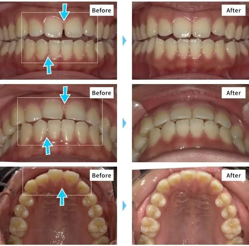 ガタガタの歯並び（叢生）の症例（マウスピース矯正キレイラインを3回治療）