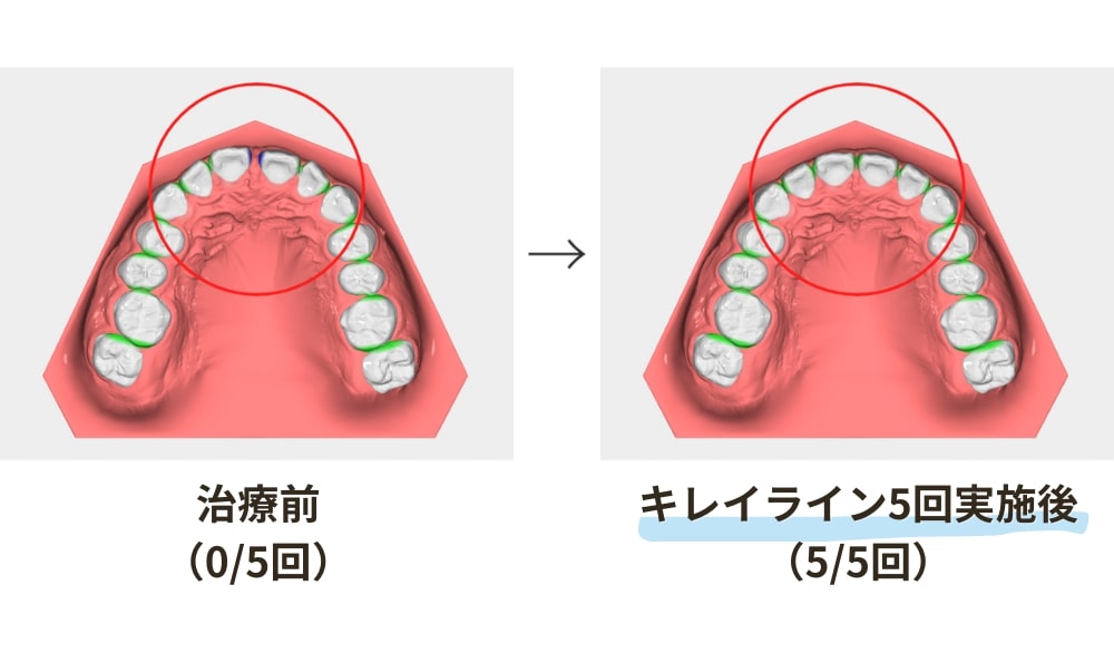 すきっ歯のシミュレーション（マウスピース矯正キレイラインを5回治療）