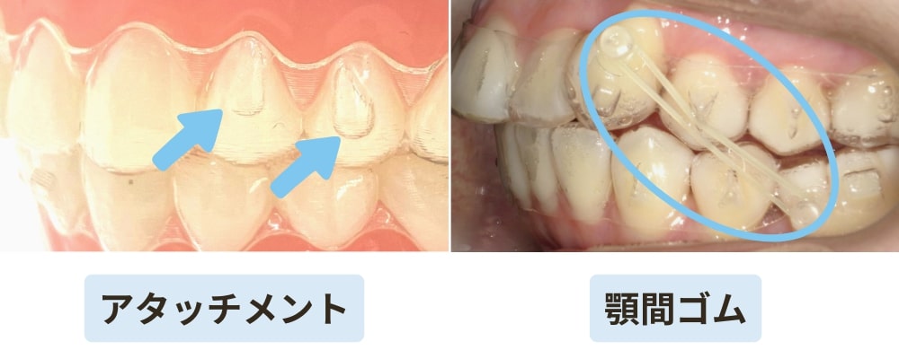 アタッチメントと顎間ゴム