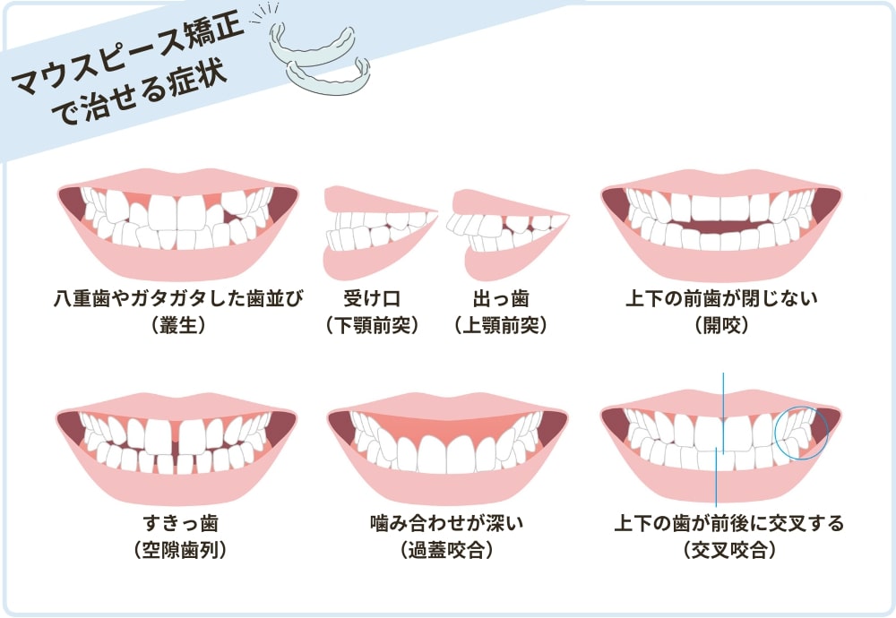 マウスピース矯正で治せる症状