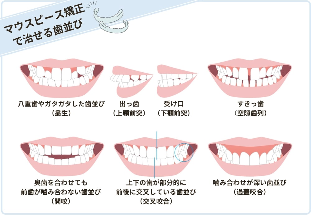 マウスピース矯正で治せる歯並び