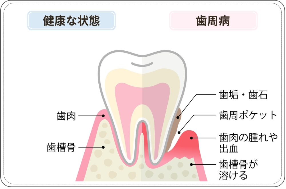 健康な状態の歯ぐきと歯周病の歯ぐき