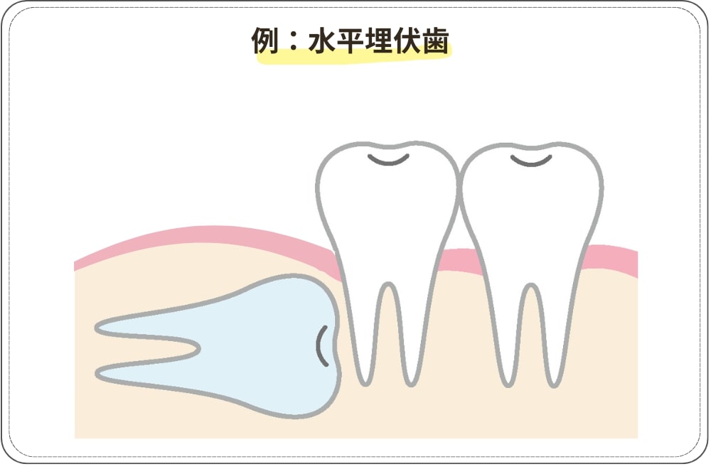 水平埋伏歯