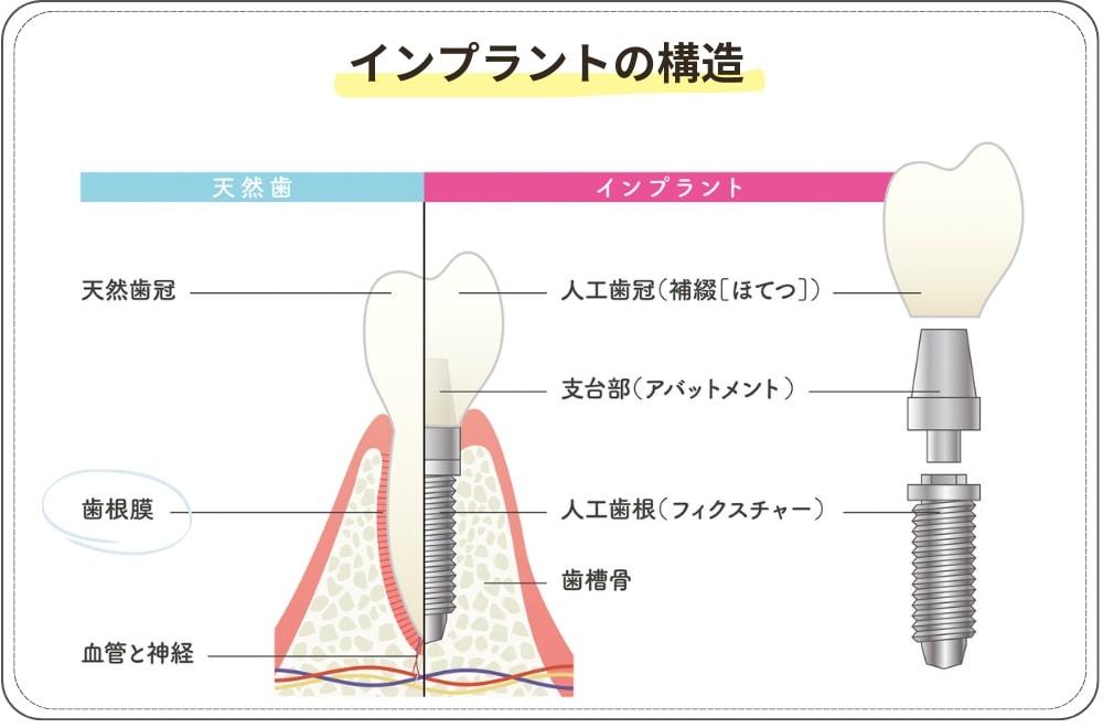 インプラントの構造