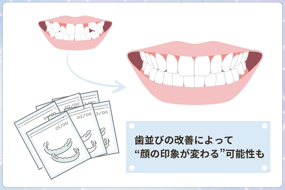 ウスピース矯正の仕組みと顔に与える影響