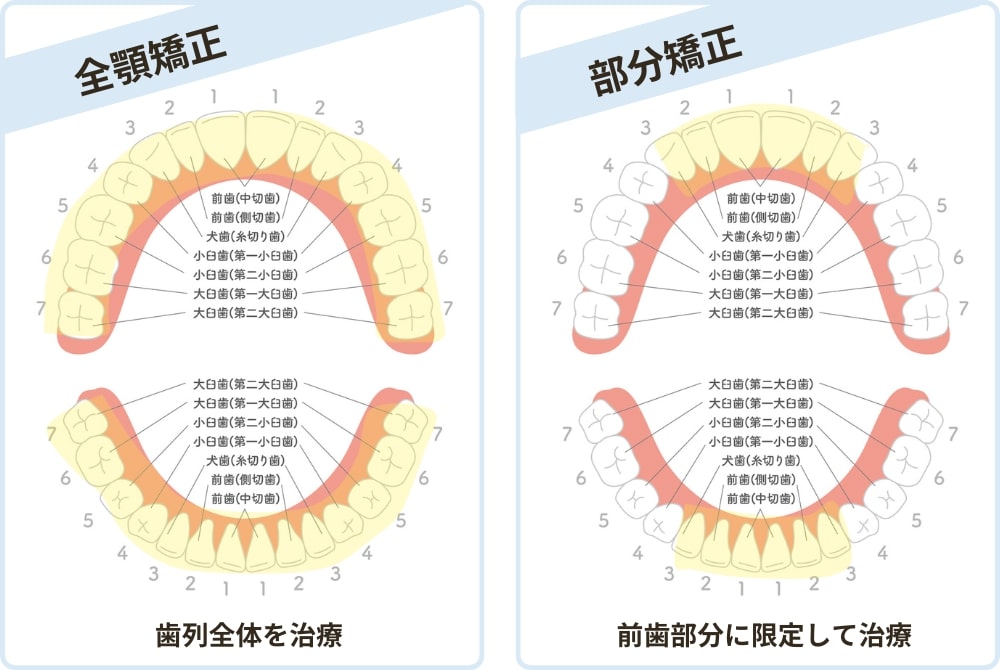 全顎矯正と部分矯正の治療範囲