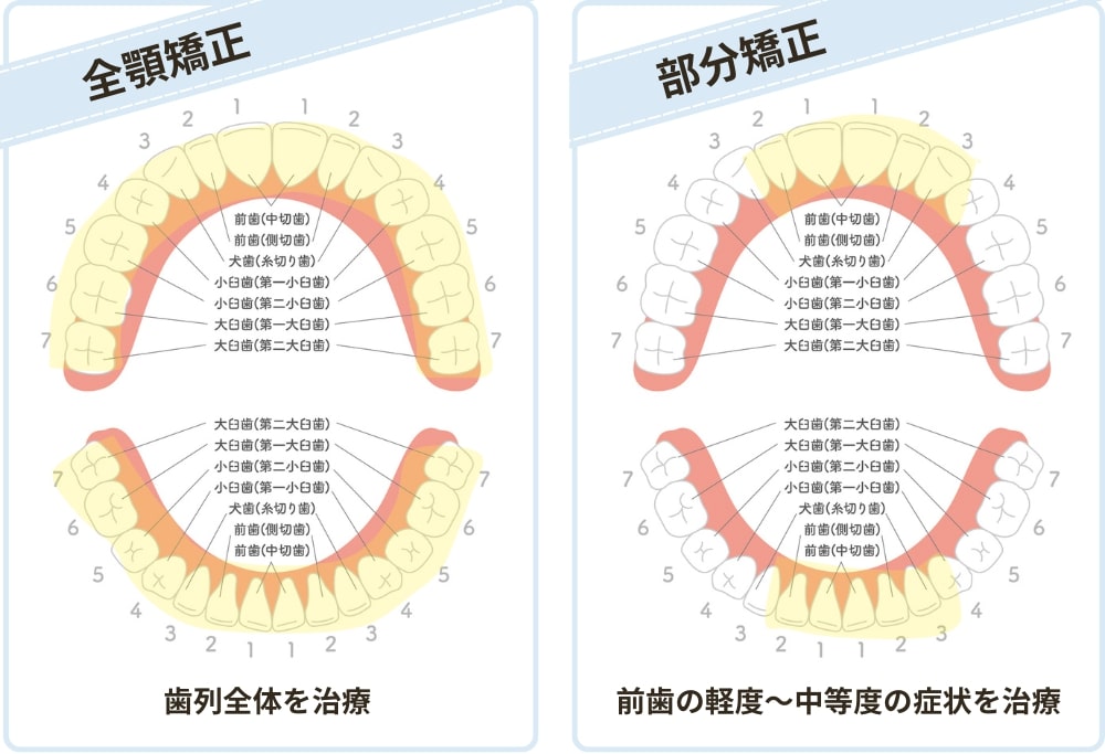 全顎矯正と部分矯正の治療範囲