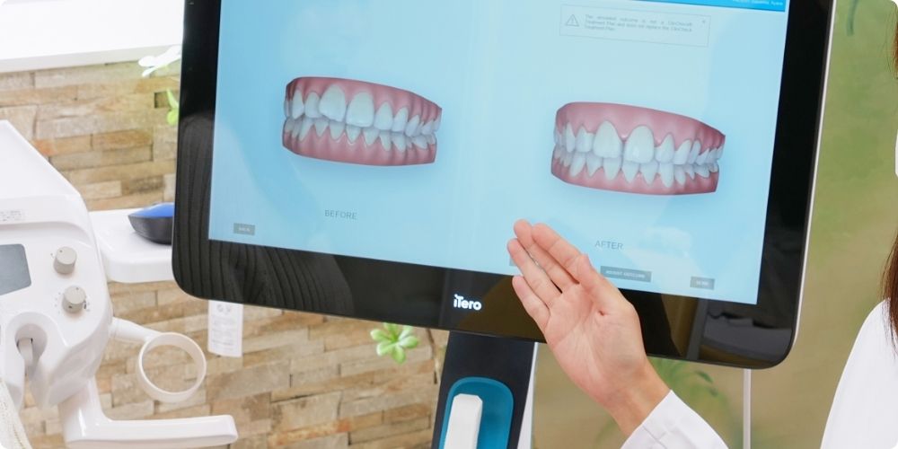 キレイラン矯正の簡易シミュレーション