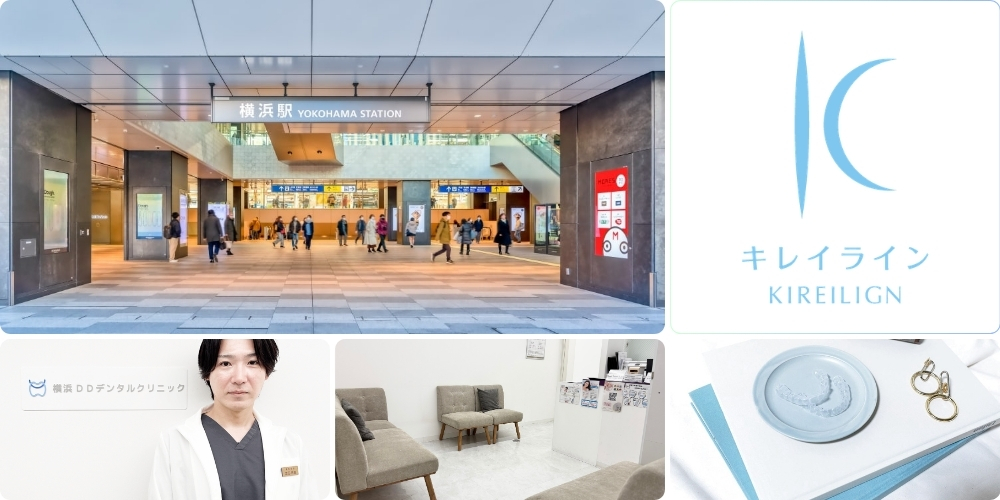 マウスピース矯正を検討中なら横浜のキレイライン提携医院でご相談を
